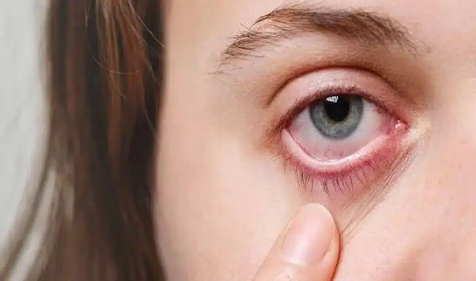 health news home remedies to prevent conjunctivitis eye flu corona of eyes